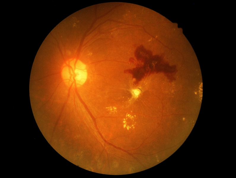 diabetic retinopathy